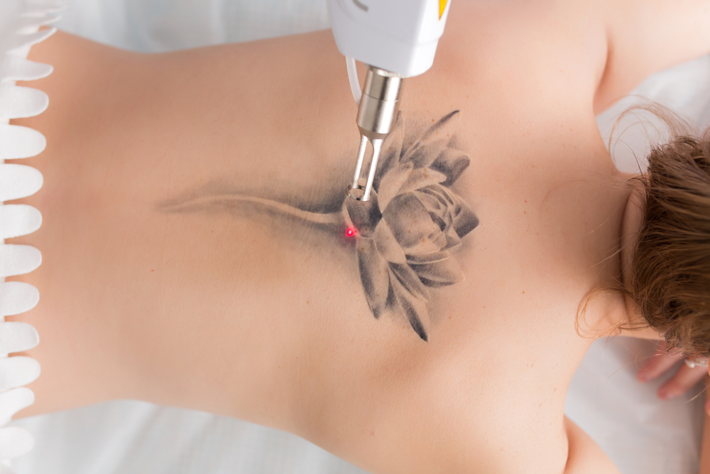 What Tattoo Removal Procedures Look Like?