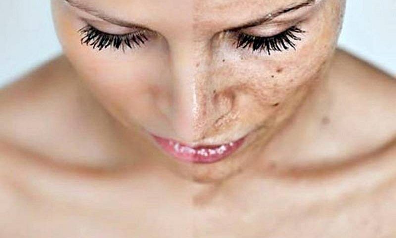 Declare War on Pigmentation Spots! Effective Remedies for Discolored Skin