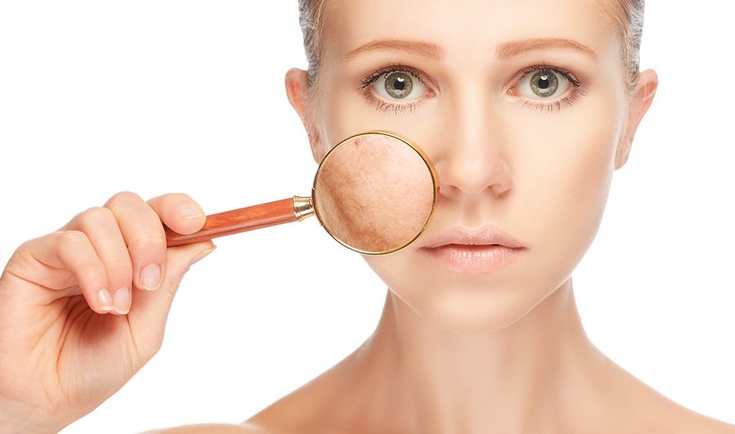 Effective Ways to Fight Pigmentation Spots